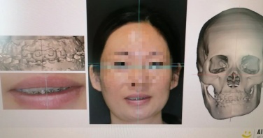 “臉歪”女子正畸后重塑自信面容 專家揭秘牙齒矯正奧秘